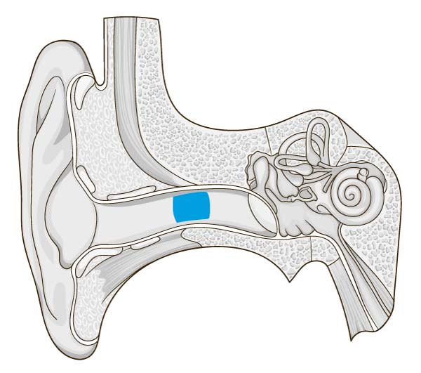 6 Causes of Ringing in the Ear & Preventing Tinnitus | Buoy Health